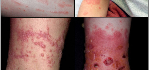 get rid of poison Ivy rash