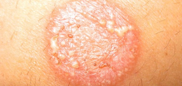 how to get rid of ringworm