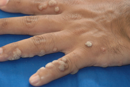 warts on hands