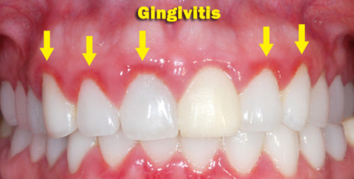 gingivitis