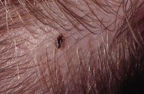 get rid of head lice