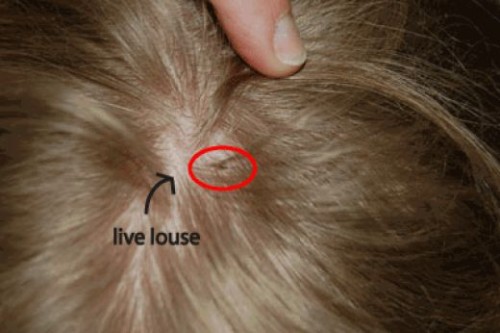 head lice pictures remedy