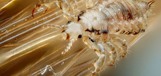 head lice pictures home remedy