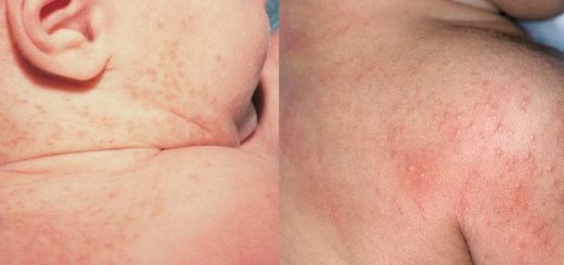 heat rash on baby