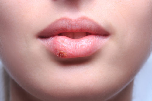 herpes on lip