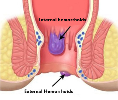 internal hemorrhoids pictures