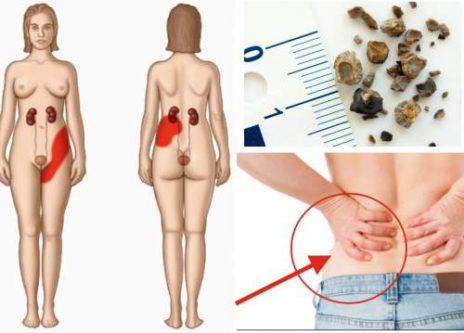 kidney stones