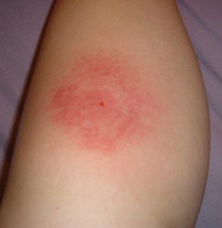 mosquito bites