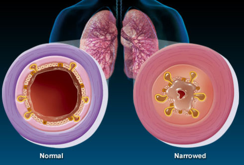 phlegm in lungs pictures