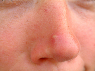 pimple on nose pictures