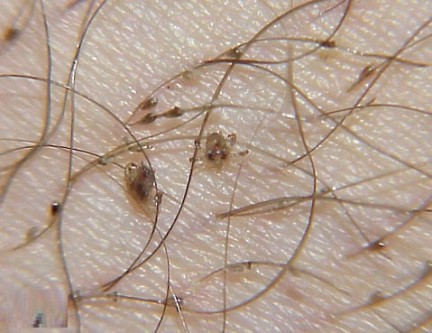 pubic lice pictures