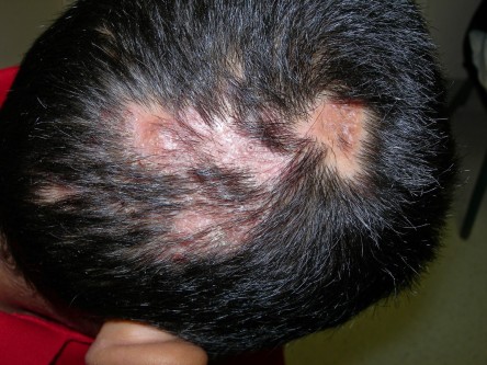 ringworm on scalp pictures