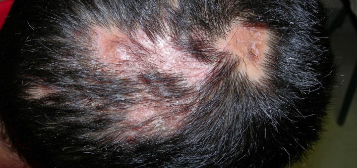 ringworm on scalp pictures