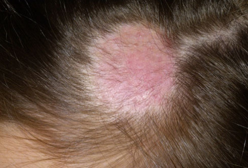 get rid of ringworm on scalp