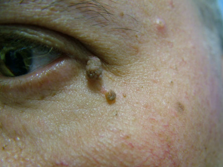 skin tags on face pictures