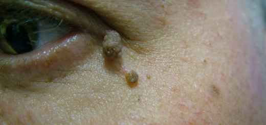 skin tags on face pictures