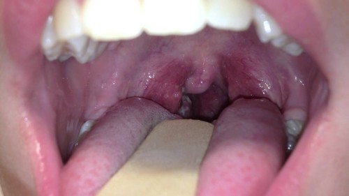 sore throat pictures