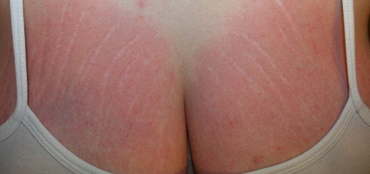 stretch marks on breasts