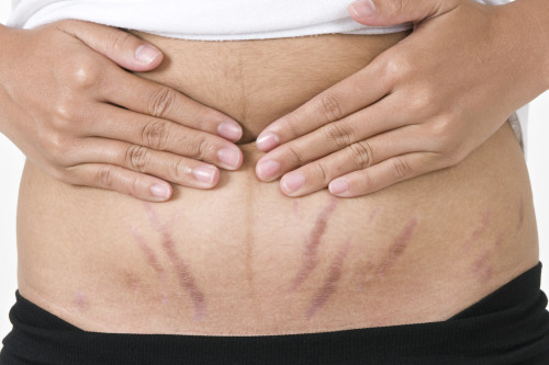 get rid of stretch marks on stomach