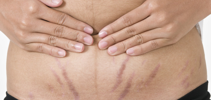 get rid of stretch marks on stomach