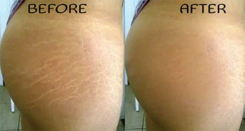 get rid of stretch marks on thighs