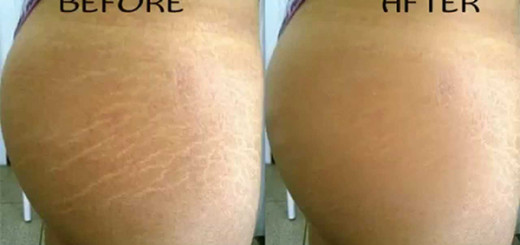get rid of stretch marks on thighs