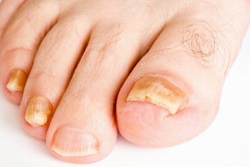 get rid of toenail fungus