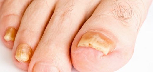 get rid of toenail fungus