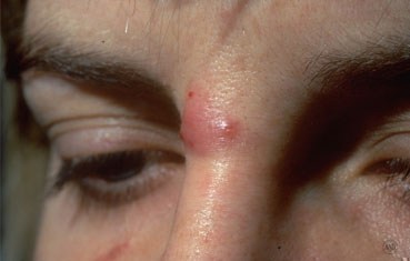 under-skin-pimples-pictures-2