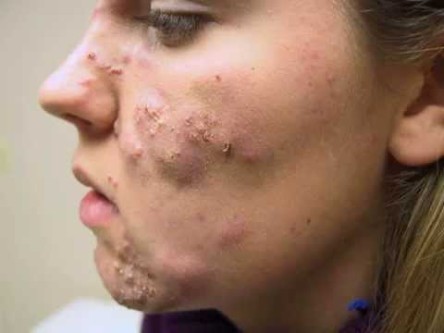 get rid of under skin pimples