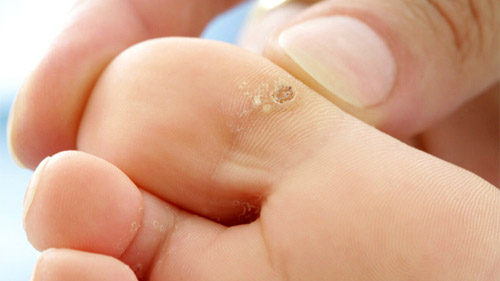 warts on feet