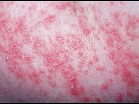 yeast infection
