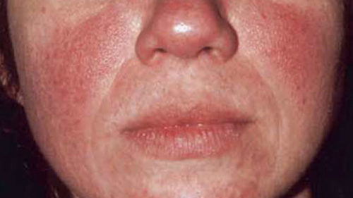 Red Spots on Face