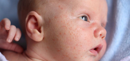 baby rash on face