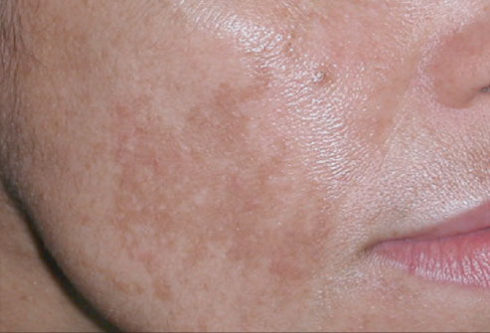 brown spots on face