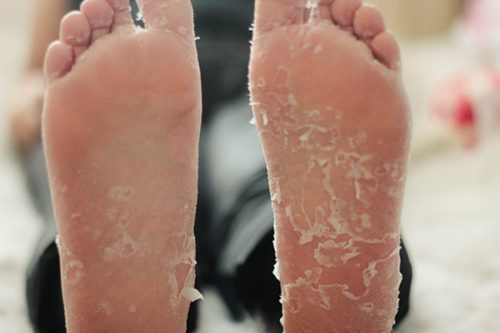 dry skin on feet