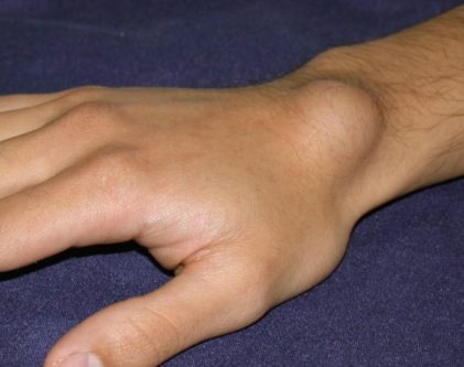 ganglion cyst