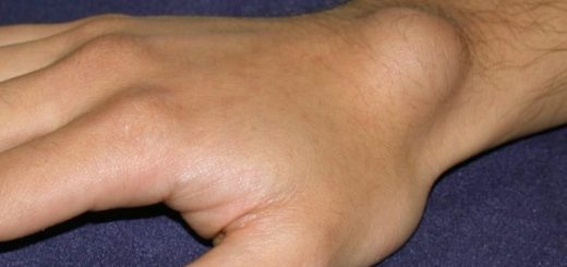 ganglion cyst