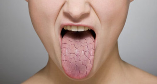 get rid of a dry mouth