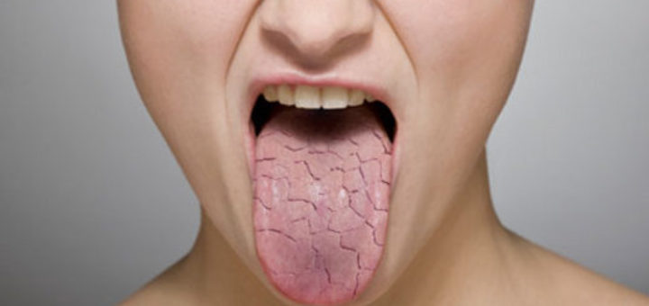 get rid of a dry mouth