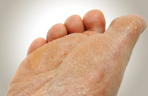 get rid of foot fungus