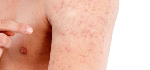 keratosis pilaris