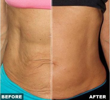 get rid of loose belly skin