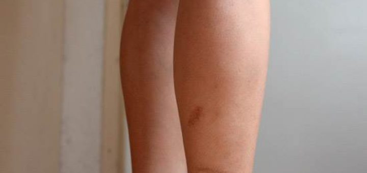 get rid of scars on legs