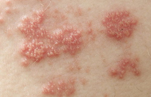 get rid of shingles