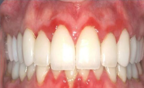 get rid of swollen gums