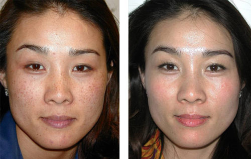 hyperpigmentation on face