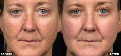 hyperpigmentation on face