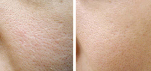 large pores before after