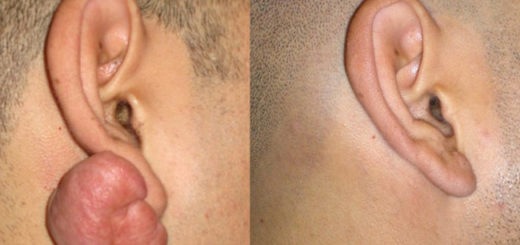 leloids on ear